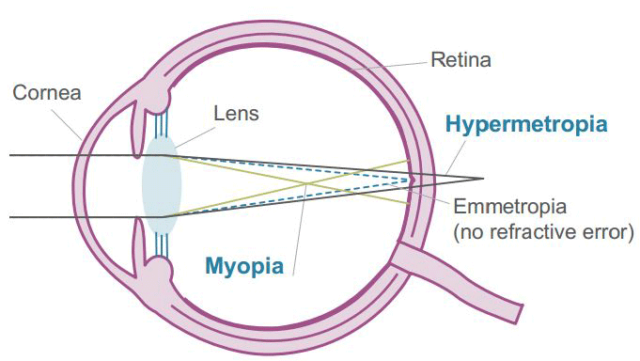 Difference Between Myopia, Hypermetropia And Presbyopia (With Diagram ...