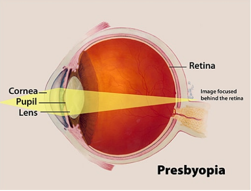 myopia és presbyopia látási szerveket fektetnek a héten